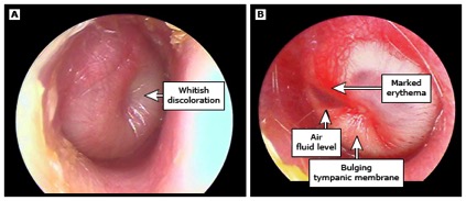 Ear Infections In Adults And Children Brevard Physicians Associates